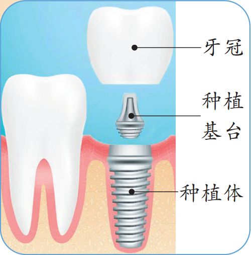 种植牙费用巨贵哪种牙较实惠,种牙是牙齿贵还是牙体贵