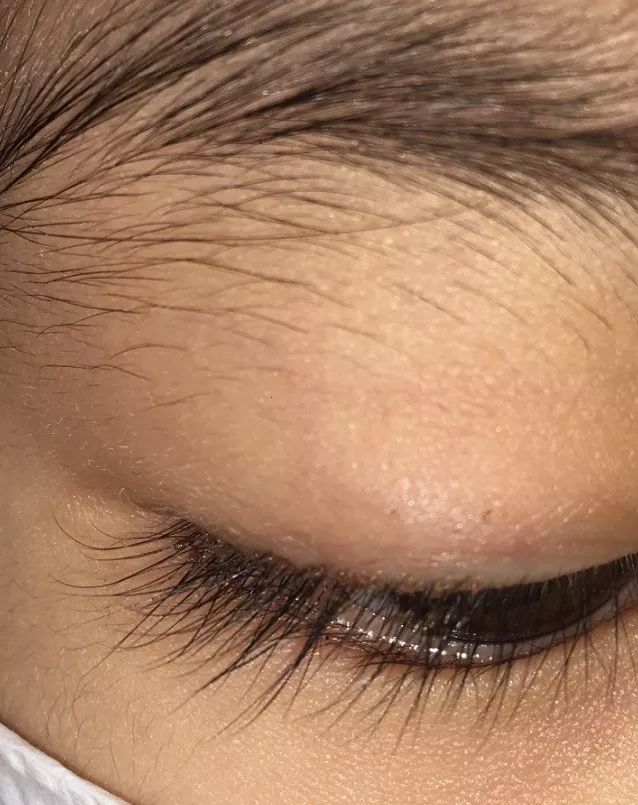 5岁女孩眼睛有虱子,宝宝一直揉眼睛是长虱子吗