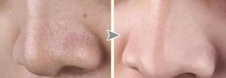 草莓鼻去黑头好物推荐使用,草莓鼻去黑头导出液