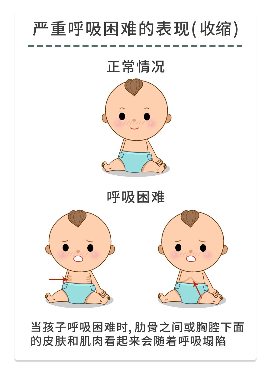 很危险！娃咳嗽发出这种“声音”是在求救，不重视会危及生命