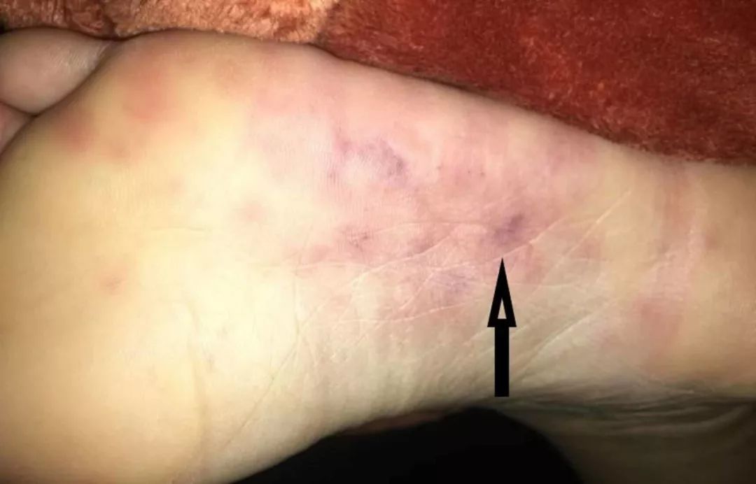 感染性心内膜炎的护理常规记录,新生儿感染性心内膜炎