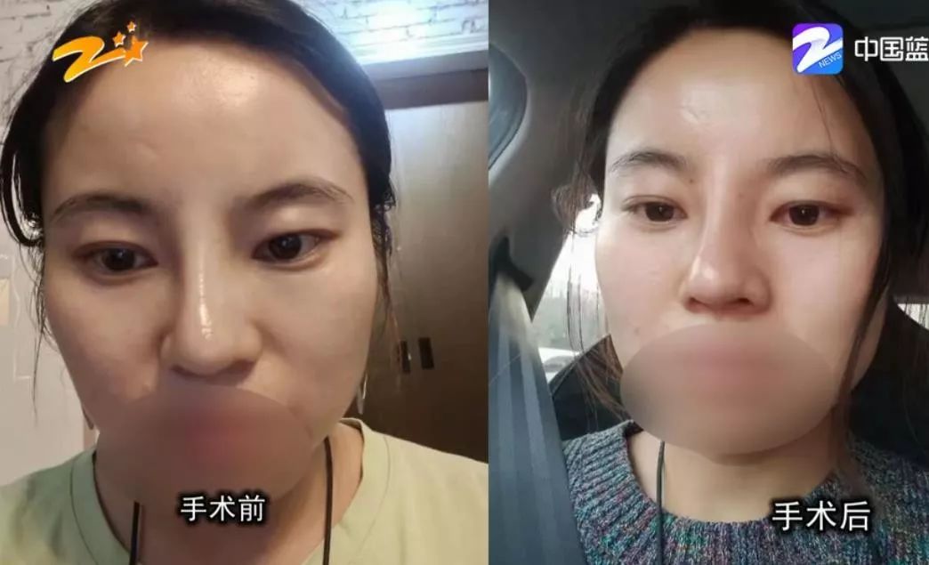 鼻子歪了呼吸不畅怎么办,鼻子骨头歪了呼吸不顺畅怎么办