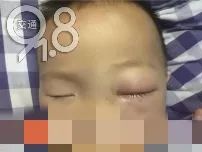 4岁小孩眼睛被腐蚀,强酸液体滴进孩子眼睛