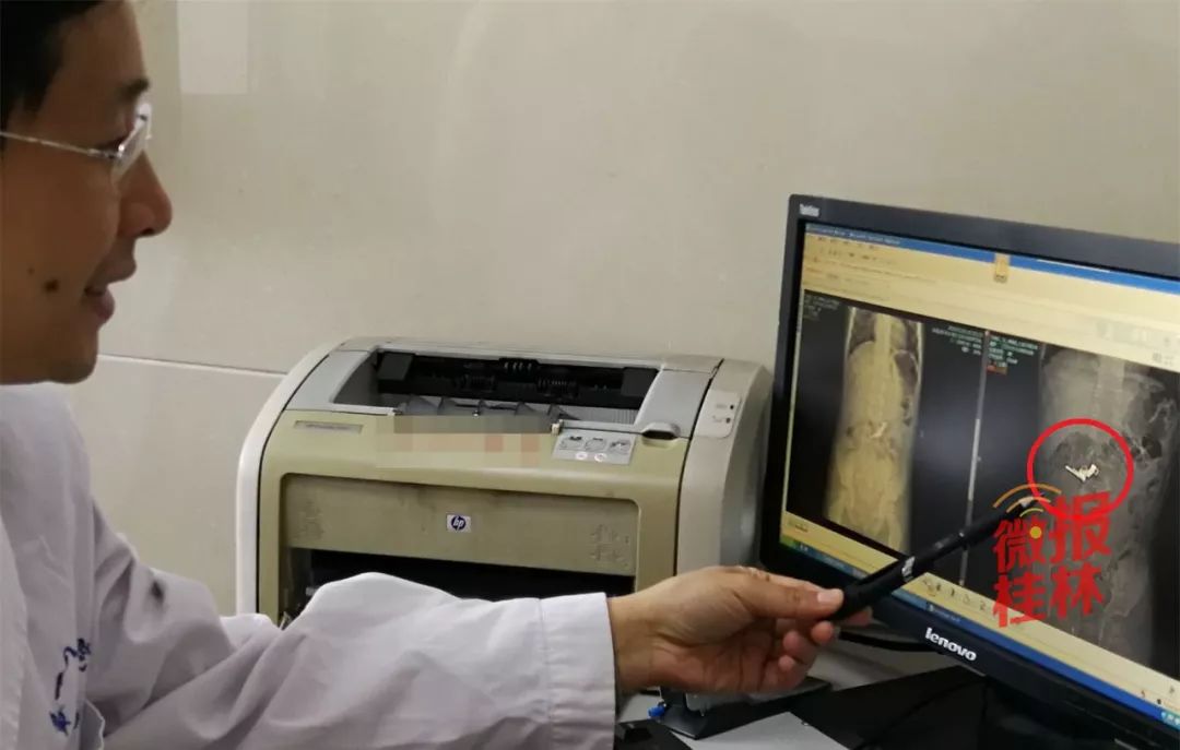 一个小孩吃零食吃出一把枪,广西3岁男孩吃辣条