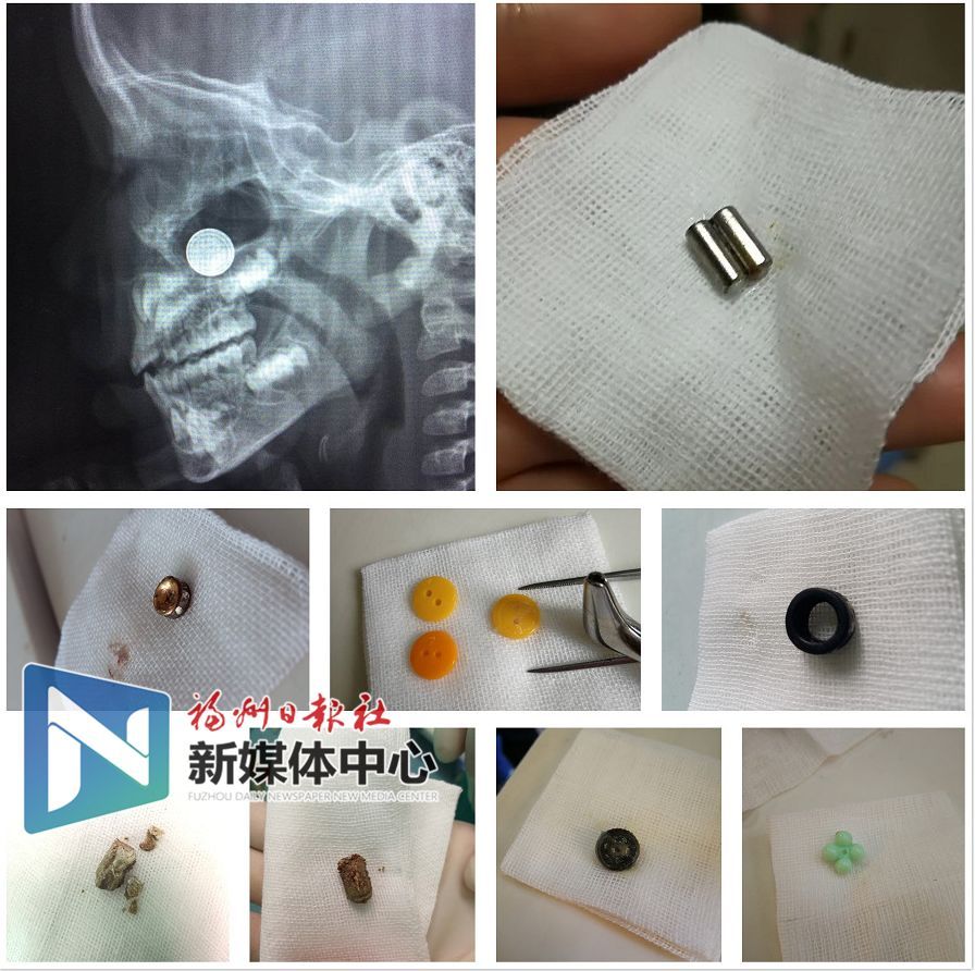 2岁孩子误吞2厘米钉子,4岁小孩误吞钉子