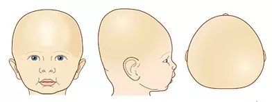 婴儿头睡扁纠正示意图,小孩的头睡扁了怎么办