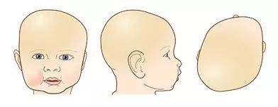 婴儿头睡扁纠正示意图,小孩的头睡扁了怎么办