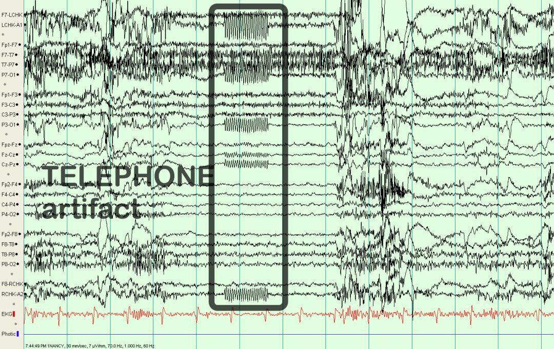 脑电图伪差图,脑电图伪差图谱