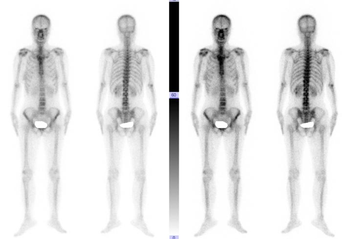 胸椎瘤手术,胸椎旁肿瘤手术成功率