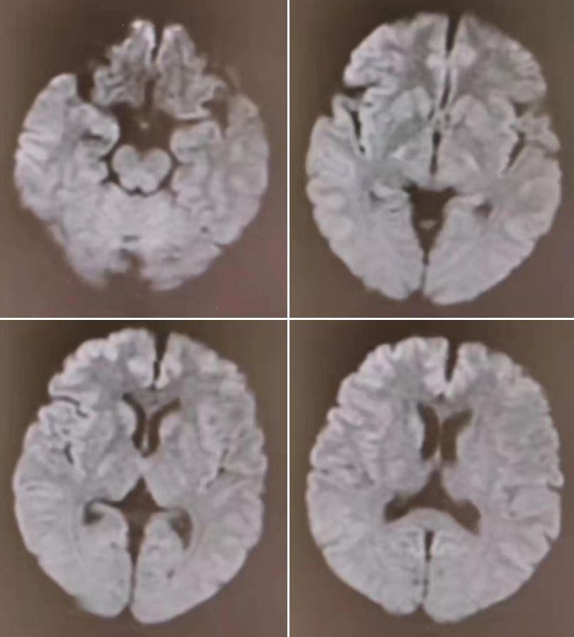 高氨血症有哪些表现,高氨血症