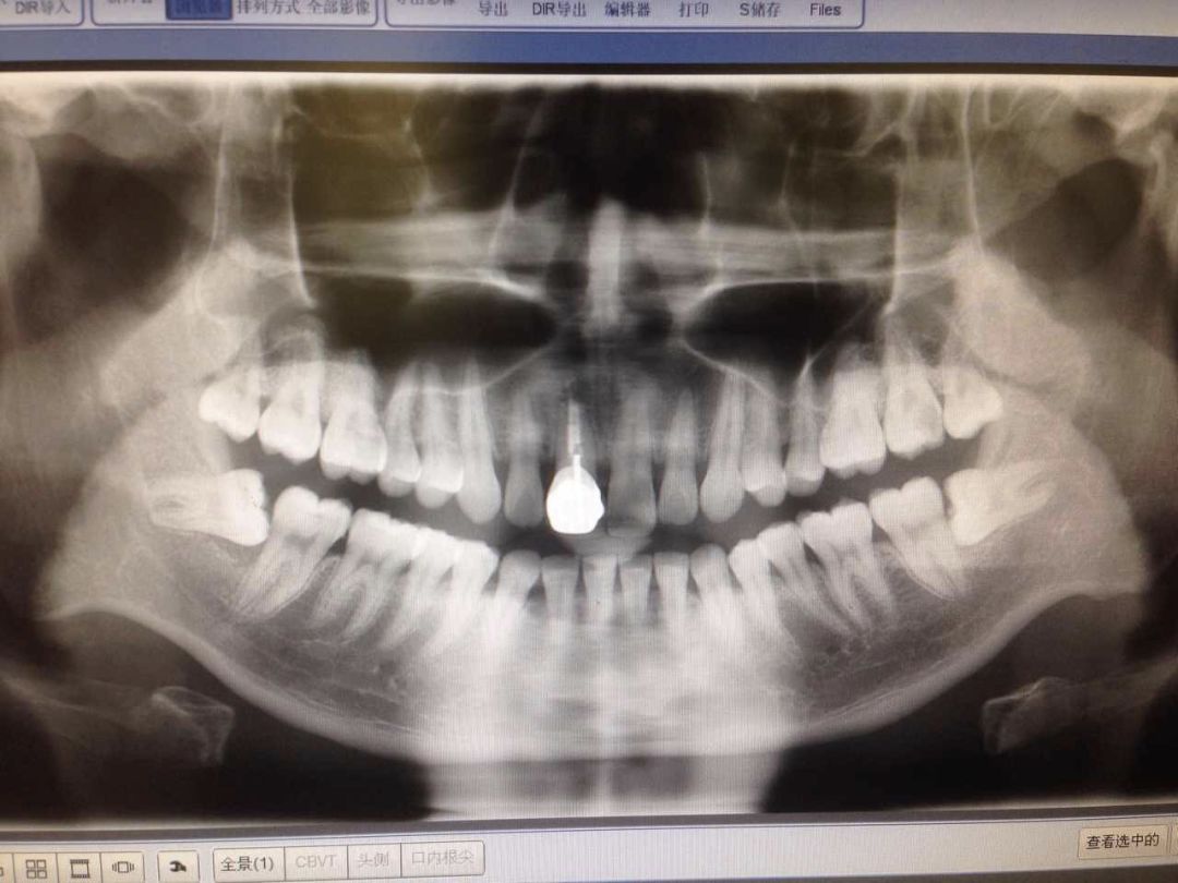 拔智齿的全过程科普,拔智齿细致操作过程