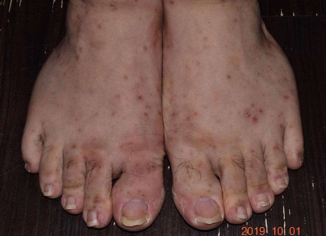 大人感染轮状病毒一直拉肚子,大人得肠病毒