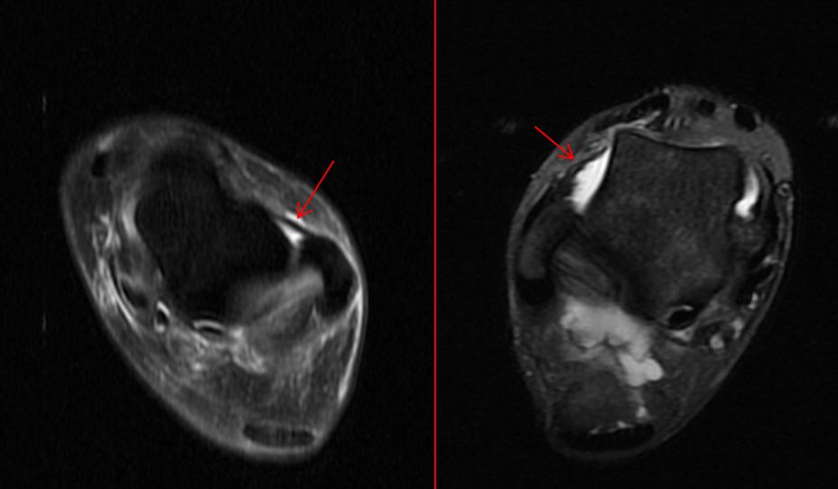 崴脚了医生建议拍片吗,崴脚后核磁可以看到软骨损伤么