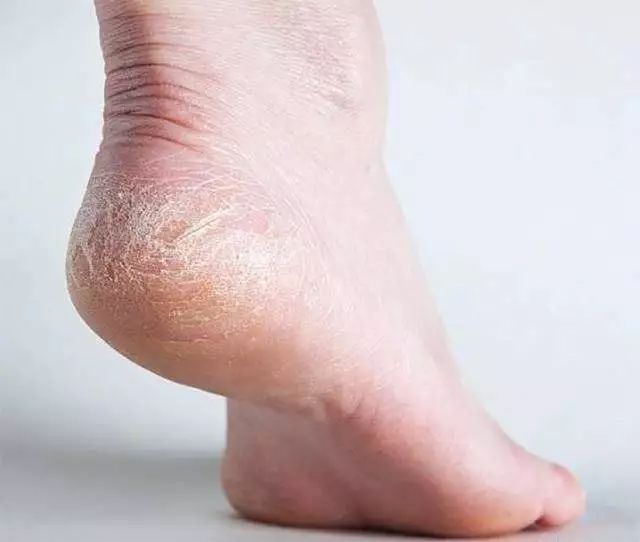 呵护手足|戴手套=精油SPA？还不耽误玩手机？30分钟急救手膜足膜，死皮老茧全消失，让你从头嫩到脚