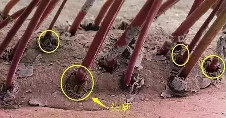 头皮痒头屑多有头螨怎么办,头螨大块头屑怎么治好得快