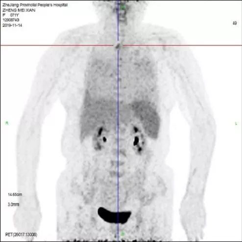 肺部感染鉴别诊断病例,双肺感染病例报告