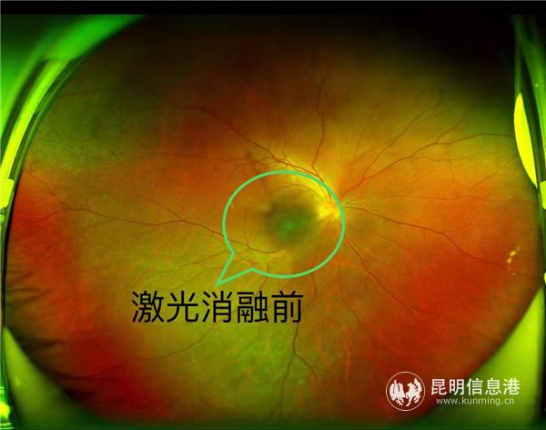 高度近视飞蚊症动手术,三十岁高度近视飞蚊症