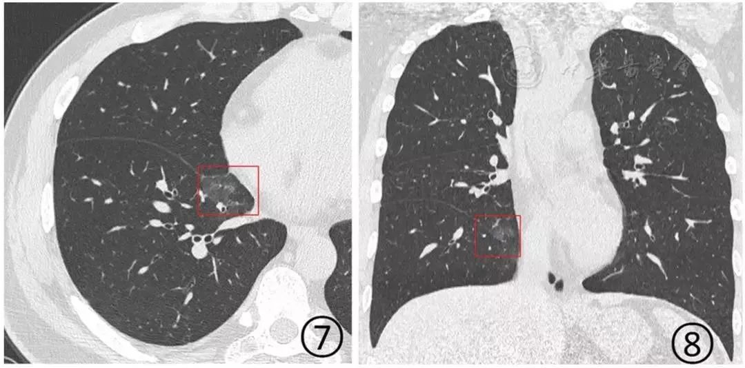 新冠肺炎影像演变过程,新冠肺炎胸部影像学特点有哪些