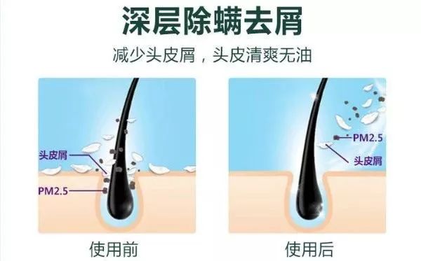 头上又油又有头皮屑又痒怎么办,头上又痒又油有头屑