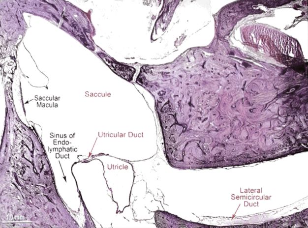 梅尼埃病深度解析,梅尼埃病病理解剖