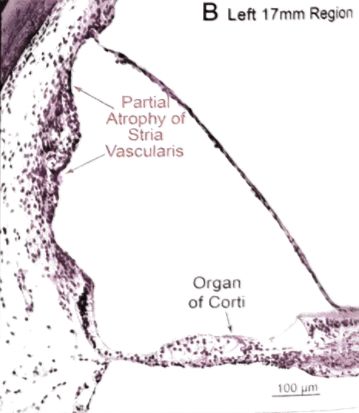 梅尼埃病深度解析,梅尼埃病病理解剖