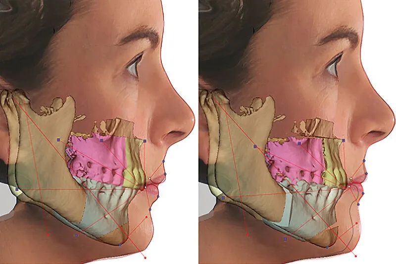 睡眠呼吸暂停是什么意思,呼吸睡眠暂停综合征英文