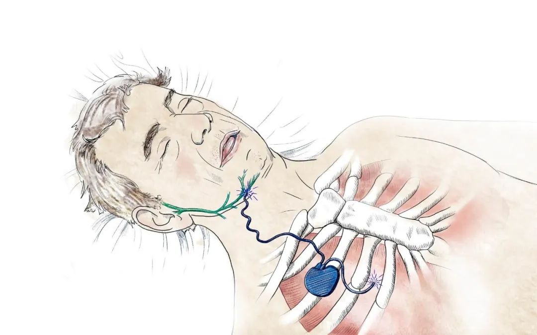 睡眠呼吸暂停是什么意思,呼吸睡眠暂停综合征英文