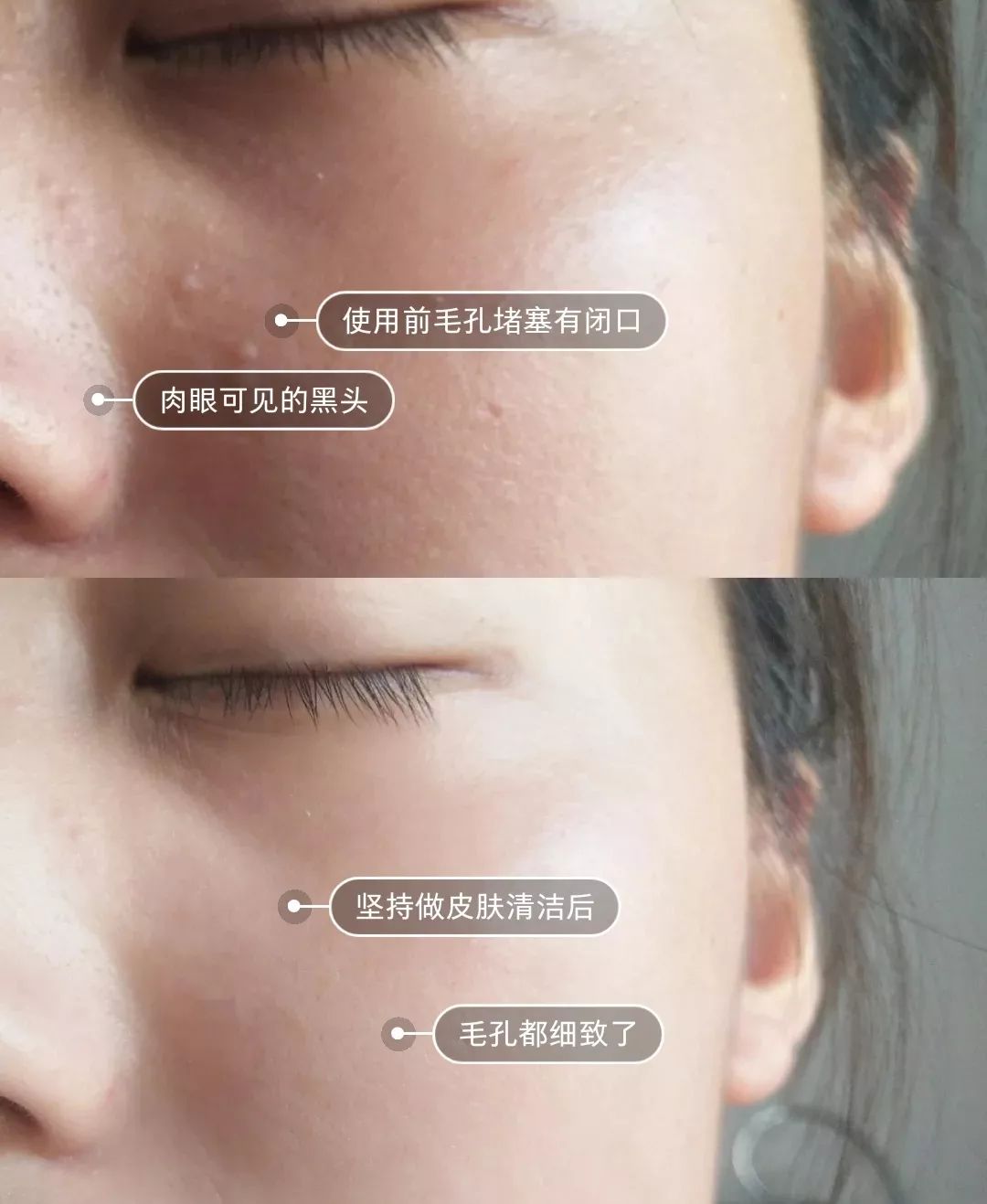 10鍒嗛挓娓呴櫎榛戝ご绮夊埡,榛戝ご绮夊埡鎸ゅ帇娓呯悊姣涘瓟绮楀ぇ