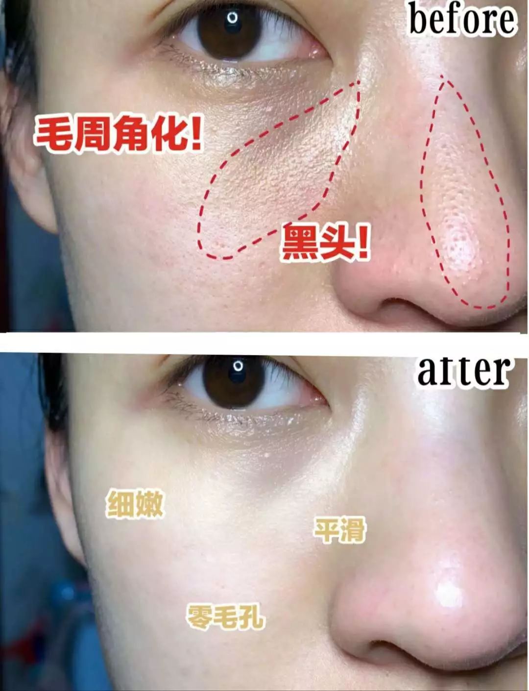 10鍒嗛挓娓呴櫎榛戝ご绮夊埡,榛戝ご绮夊埡鎸ゅ帇娓呯悊姣涘瓟绮楀ぇ