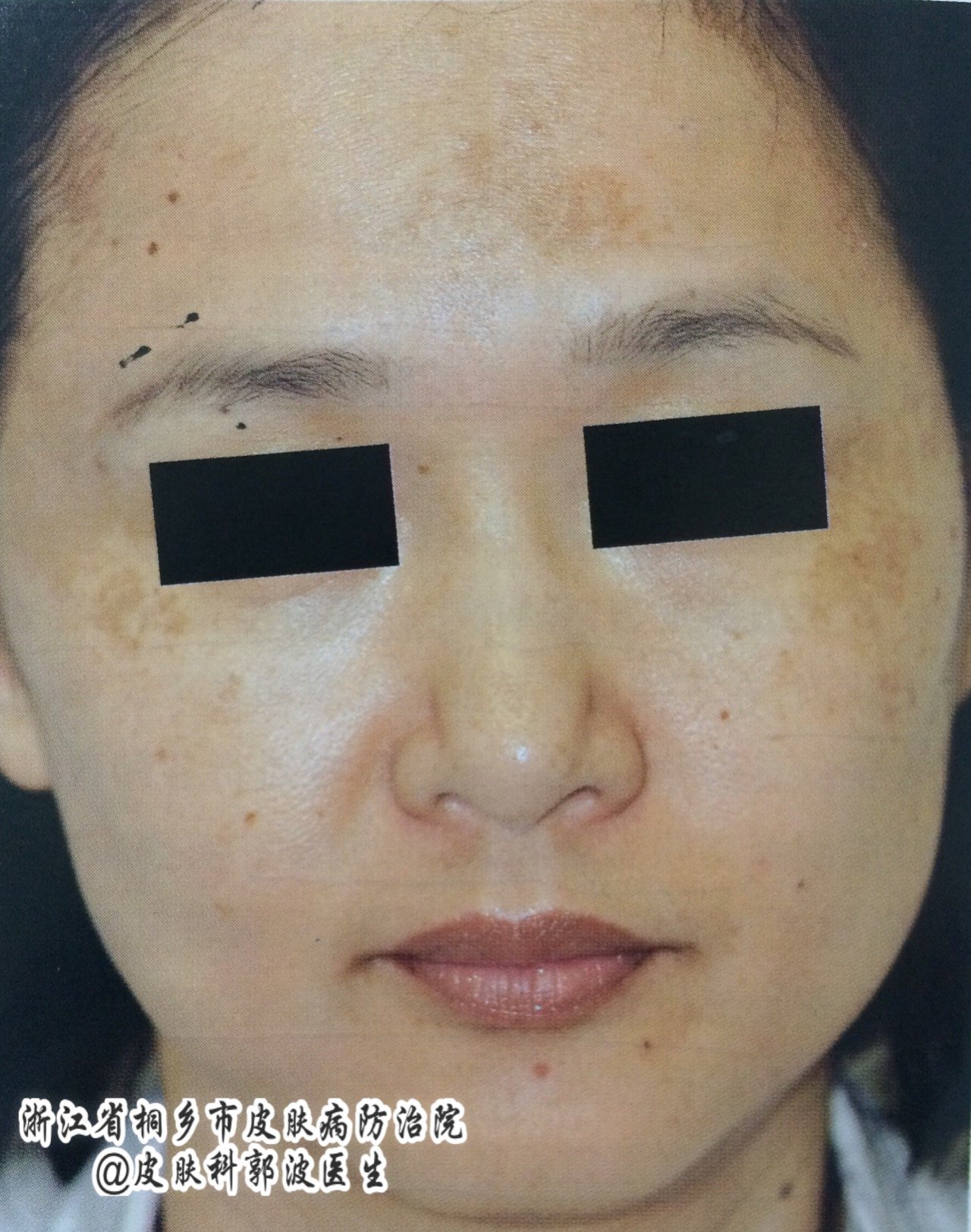 褐斑病是什么原因造成的,褐斑的原因和治疗方法