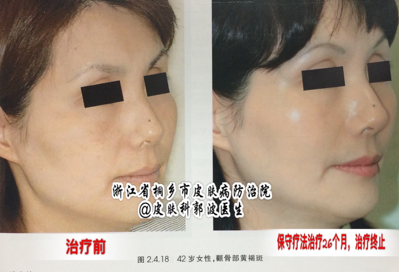 褐斑最好的消除方法,褐青色斑治疗经历