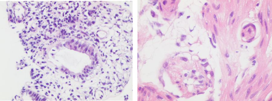 2020年淋巴瘤病理诊断必备知识点,淋巴瘤病理质控