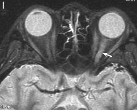 张星虎视神经脊髓炎,张星虎多发性硬化
