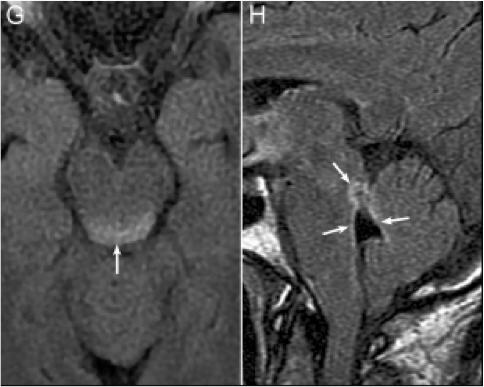 张星虎视神经脊髓炎,张星虎多发性硬化