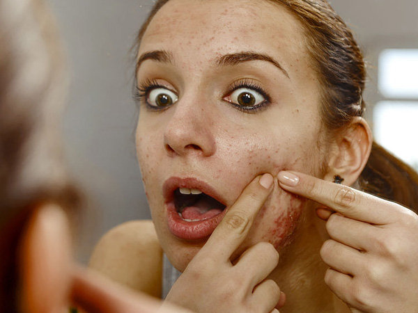 脸上有黑头怎么去除,脸上全是黑头粉刺怎么办