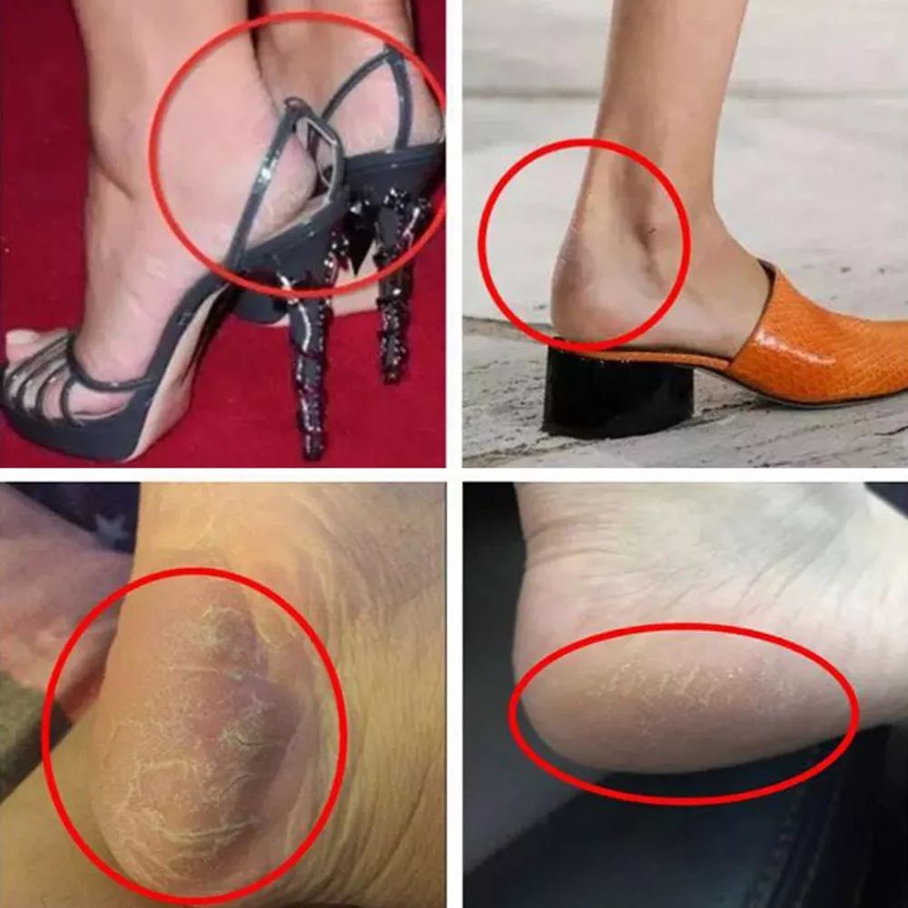 美脚神器哪个效果最好,美脚神器去角质呵护足底