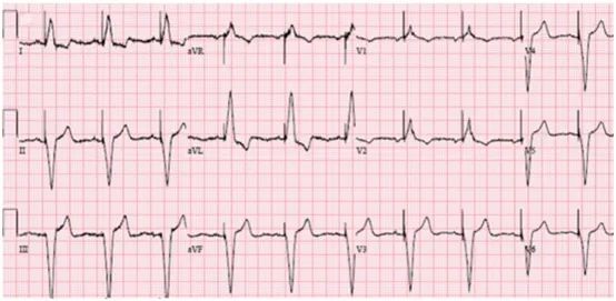 心电图显示心室起搏,心电图电极v4位置