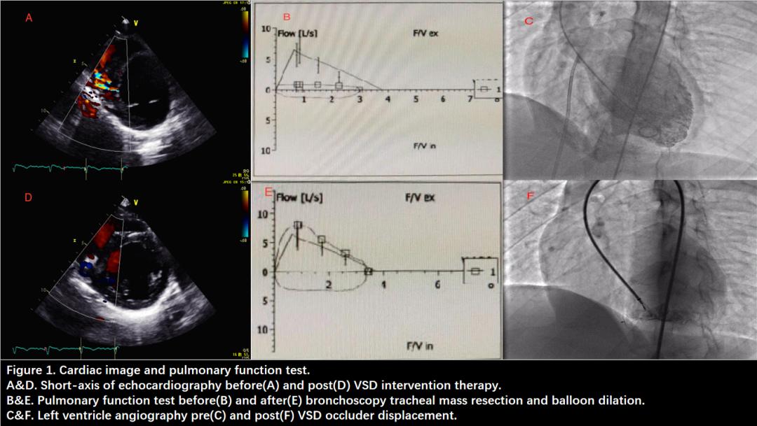 心脏室间隔穿孔如何治疗,心脏穿孔介入治疗