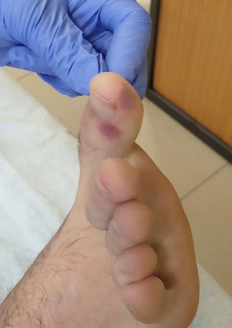 新冠感染期间脚上起疹子,新冠症状脚上起痘