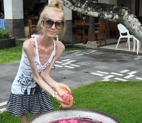 厌食症和暴食症同时出现,厌食症和贪食症的最主要的区别