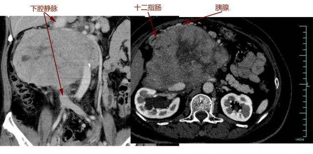 胃口变差,医生从她肚子里取出一个“足球”