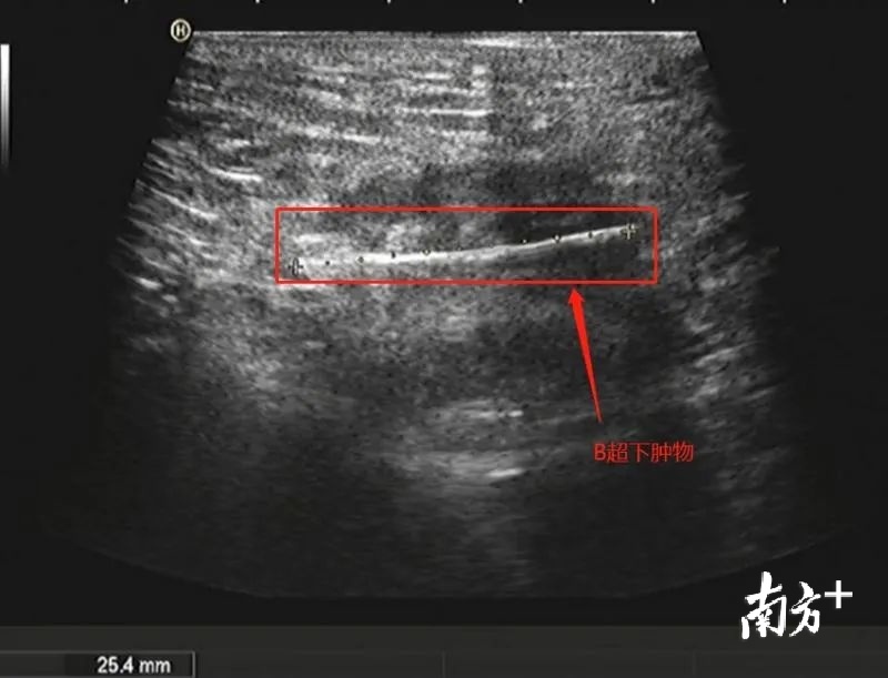 一女子怀疑得痔疮,一名女子得了痔疮结果痔疮破裂