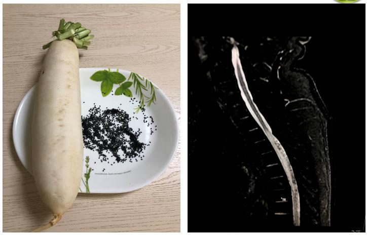 慧眼识传说:MRI的“白萝卜和黑芝麻”影像征丨病例探究