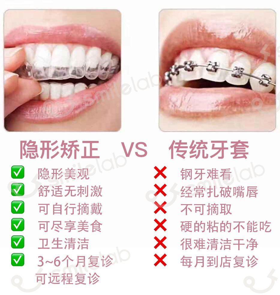 深拔牙齿矫正的潜在风险,隐形牙套的坑