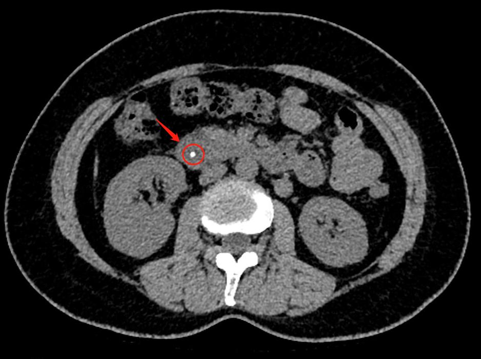 女子体内取出活虫只因爱吃这套菜,女子体内取出活虫只因爱吃这样菜