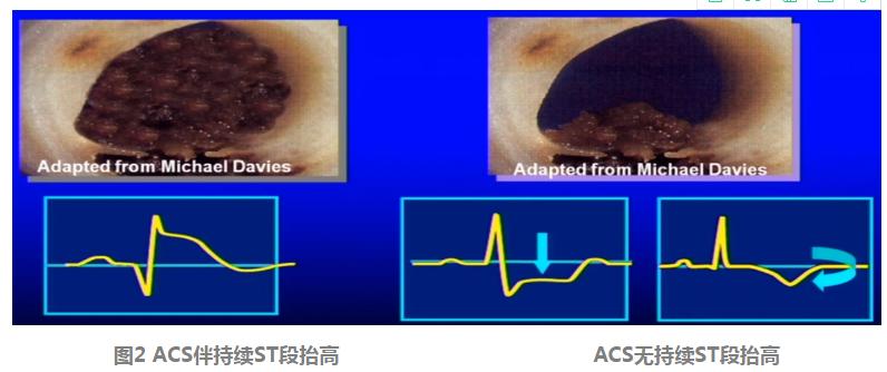 胸痛的诊断与鉴别诊断心得,急性胸痛的诊断思路和方法