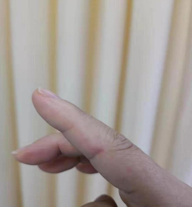 【筋伤园地】想要治疗疤痕，不妨这样试试