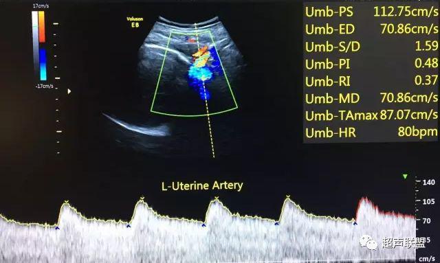 胎儿宫内窘迫通过什么检查出来的,胎儿宫内缺氧的超声视频