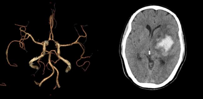 左侧大脑后动脉开窗畸形图片,脑部基底动脉开窗畸形如何治疗