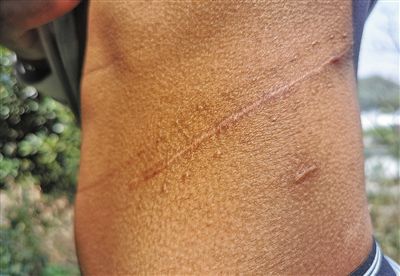 非法肾移植患者怎么办,非法移植人体器官案